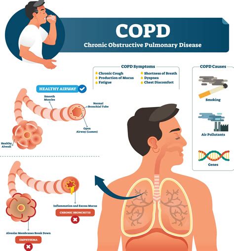 copf|Chronic Obstructive Pulmonary Disease (COPD) Symptoms